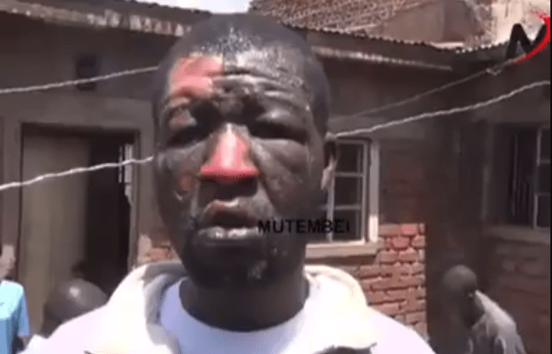 DRAMA-Migori man badly burnt by wife after argument over bedroom matters (VIDEO)
