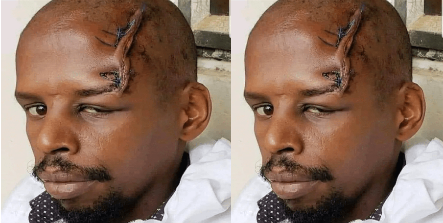 Kikuyu Man demands Ksh 6.4 Million in compensation after ex-girlfriend, who is a nurse, disfigured his face while stitching his wounds (PHOTO).