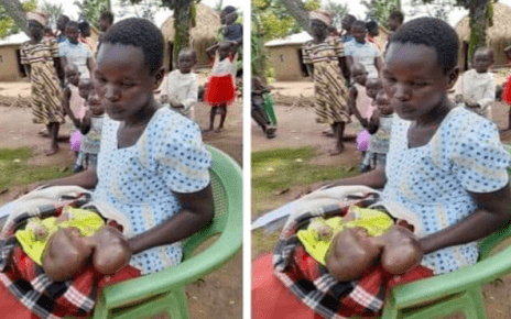 A 25 year girl from Omoloi town in Teso South sub-county is going through serious mental difficulty after her nine-month pregnancy which was expected to be a source of joy ended up being otherwise because of the infant's strange defects on the head.