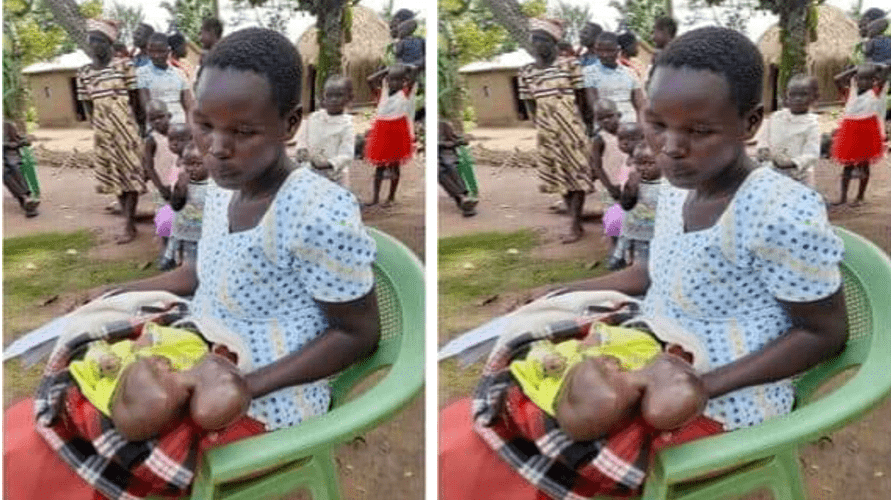 A 25 year girl from Omoloi town in Teso South sub-county is going through serious mental difficulty after her nine-month pregnancy which was expected to be a source of joy ended up being otherwise because of the infant's strange defects on the head.