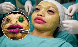 She Can’t Cry or Smile: British Billionaire Allegedly Spends $90,789 on Cosmetic Surgery to Look Like a Frog, But the Unexpected Happens